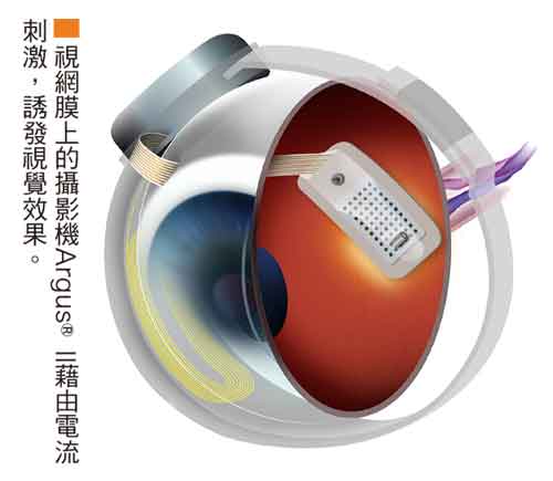 友華取得第二代人工視網膜系統61616