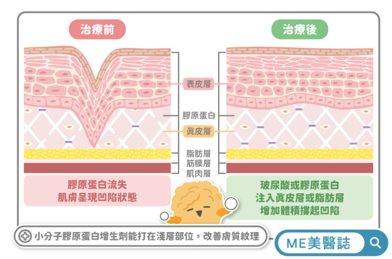 小 分 子 膠 原 蛋 白 增 生 劑 ， 能 打 在 淺 層 如 真 皮 層 等 部 位 ， 提 供 淺 層 肌 膚 修 復 的 新 選 擇 