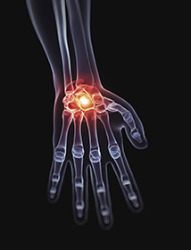 冬天小心痛風找上門