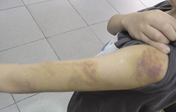 家庭失功能 兒虐事件層出不窮